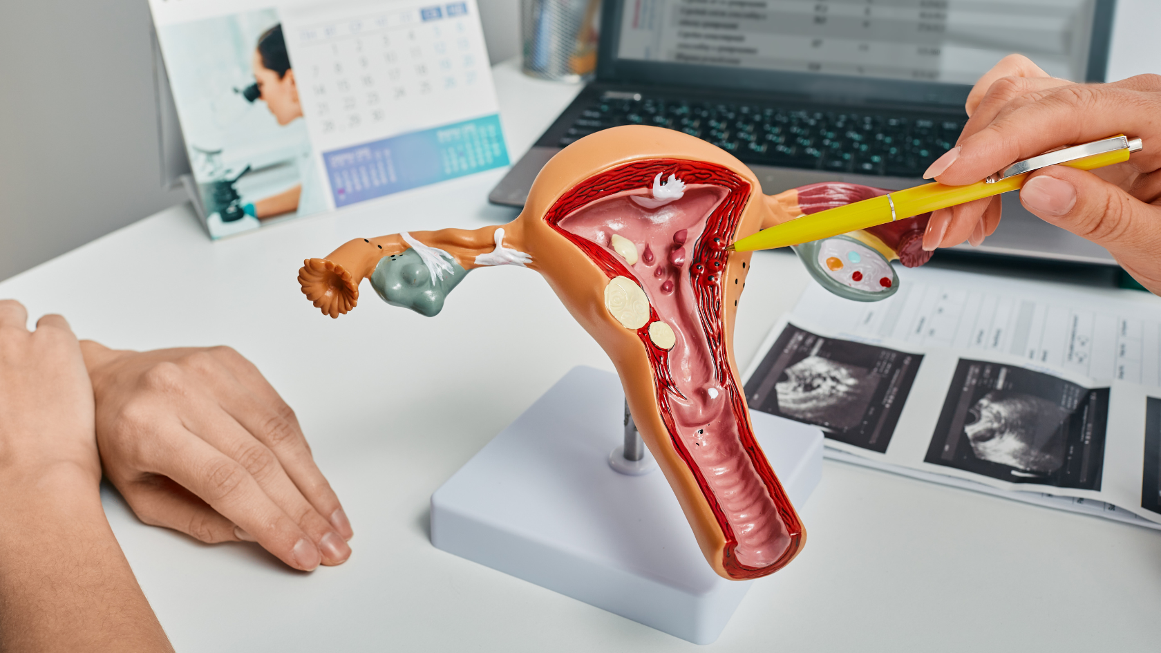 O que são Pólipos Endometriais? Uma Visão Detalhada desta Condição Ginecológica